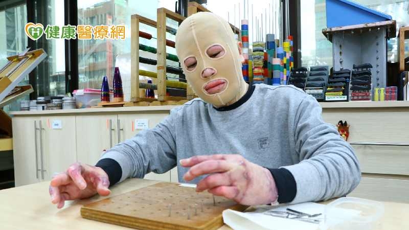 她因意外嚴重燒傷照鏡子就掉淚… 分享自身重建經歷盼助傷友勇敢重生