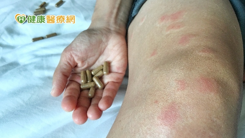 我的身體發炎了嗎？　「結締組織疾病」7大檢測法