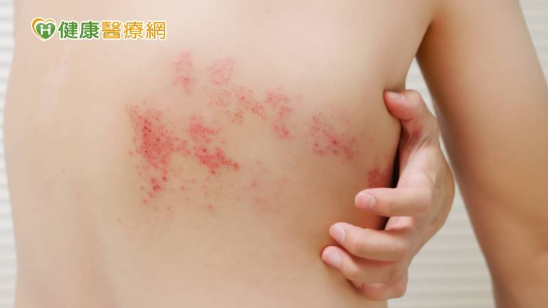 小心帶狀疱疹爬上身　施打帶狀疱疹疫苗來預防