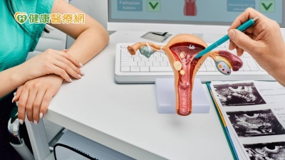 6成台灣女性有子宮肌瘤　不想開刀可選「這個手術」也能保留子宮