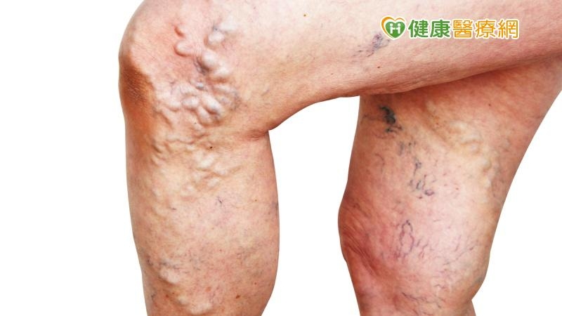 睡到一半腳抽筋痛醒！　靜脈曲張不敢開刀怎麼辦？