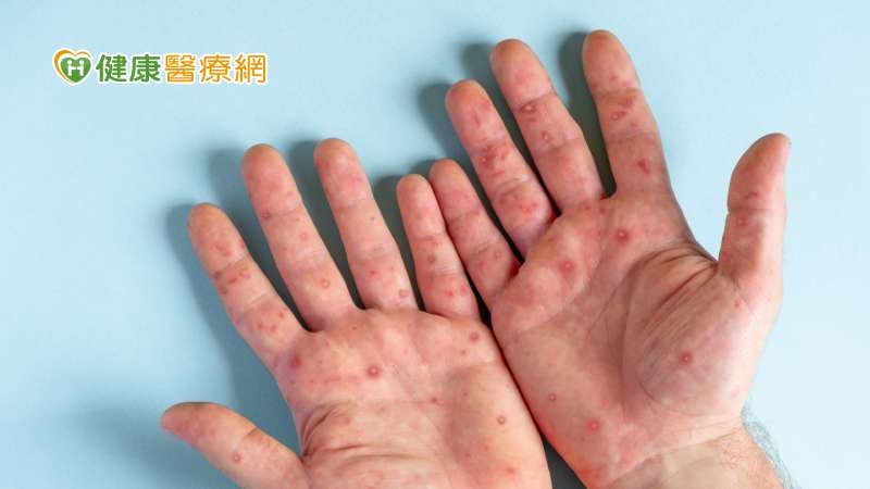 首例兒童猴痘！4歲童因家人接觸感染　疾管署提醒「這些」都是傳染途徑