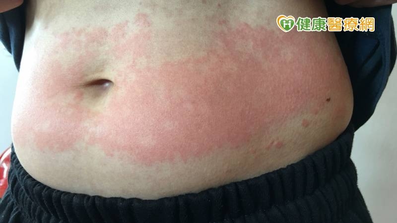 紅斑性狼瘡患者屬重大傷病　且有高風險合併腦中風