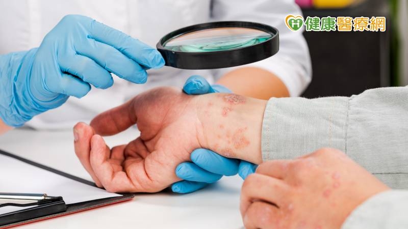 梅雨季濕疹好難受！　中醫：少吃過甜、奶製品