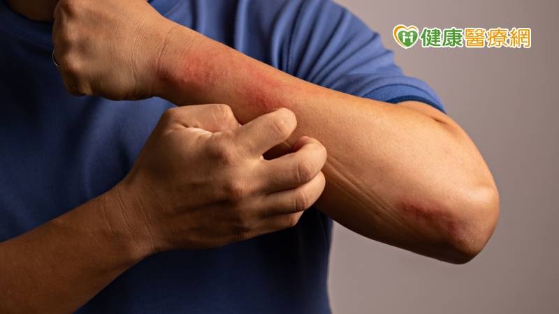 異位性皮膚炎總是搔抓到流血　中藥內服外敷改善體質