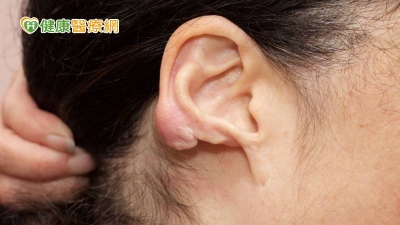 穿耳洞長出「蟹足腫」怎辦？　醫提５療法祛退異常疤痕
