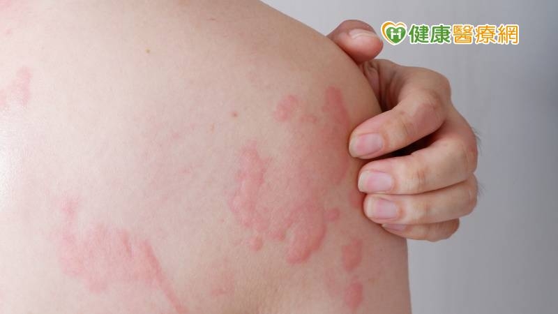 男子服感冒藥全身搔癢、冒皮疹　醫揭「1原因」惹禍：還可能致命