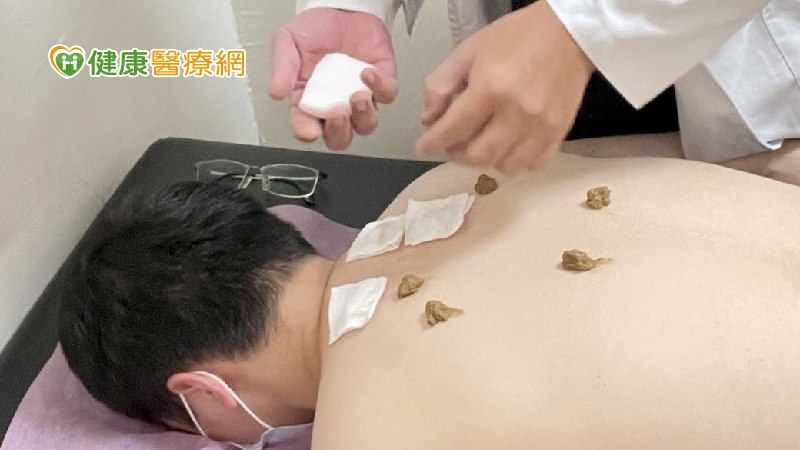 夏季三伏貼改善過敏！　誰不適合使用？使用後要注意哪些？