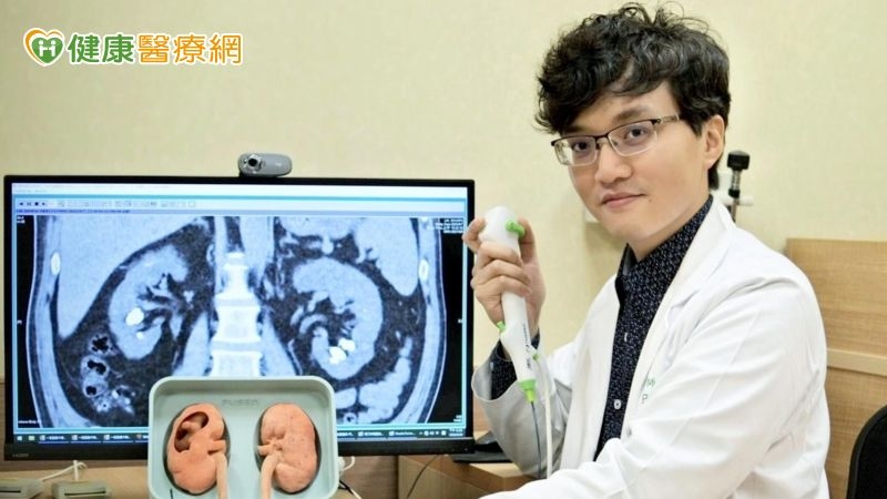 腎結石化作滿天星斗，「新型軟式輸尿管鏡手術」無刀口擊碎取出