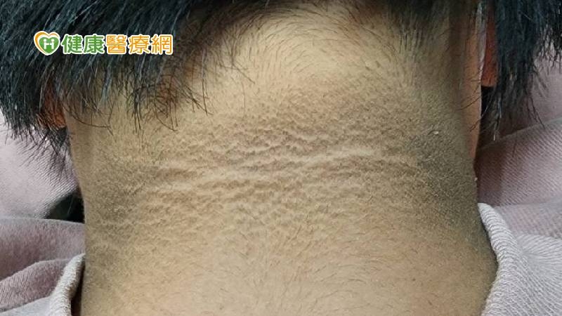 小時候胖要注意！國中生肥胖出現「黑色頸紋」　嚴重恐演變成糖尿病