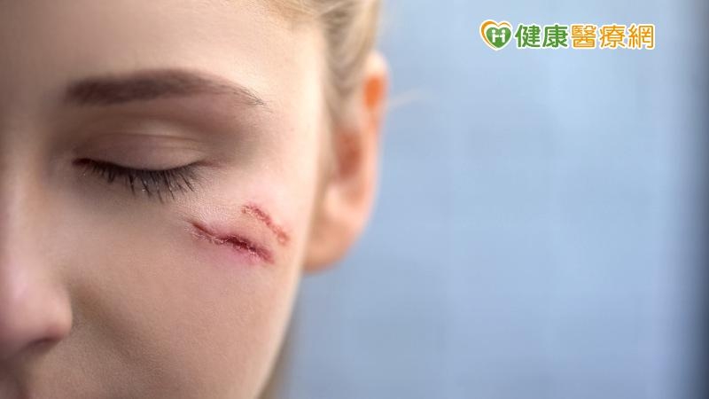 改善破相疤痕　拿回你的人生主導權