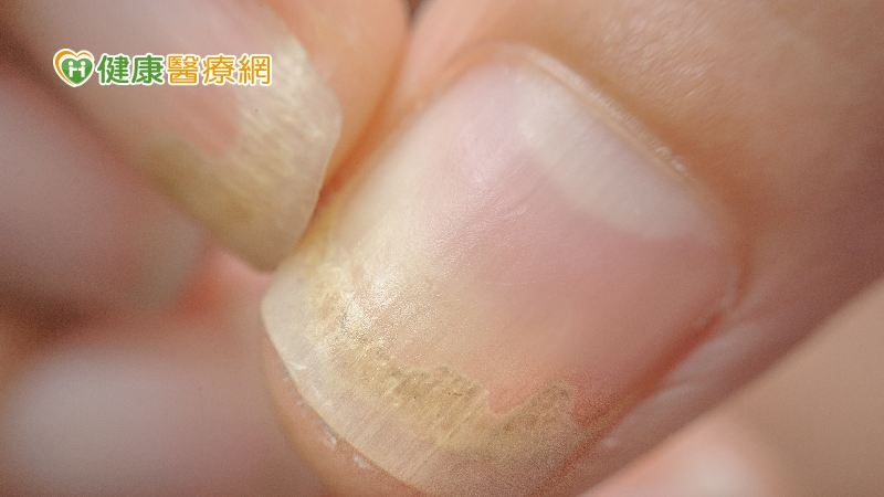 指甲變色、變厚、變形不一定是灰指甲！　「這些」都可能產生指甲症狀