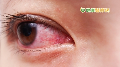 想驅蚊卻誤噴眼睛引發灼傷劇痛！　醫囑使用消毒劑5重點