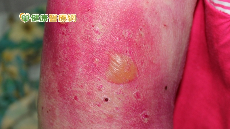 全身水泡、抓破恐引發感染致死! 長者當心「類天皰瘡」