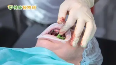 人工牙根掉入鼻竇　口外內視鏡手術急救