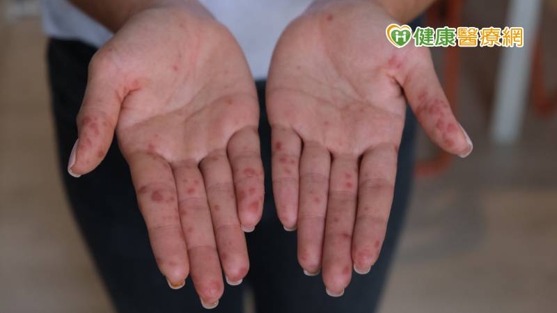 20多歲女雙手佈滿紅疹怵目驚心　竟是大人腸病毒