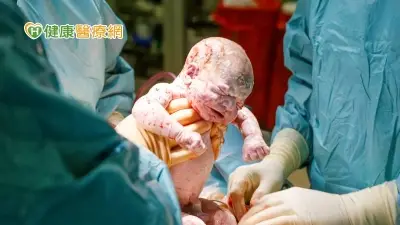 剖腹產同時切除卵巢　英國4名婦女接受突破性「二合一手術」