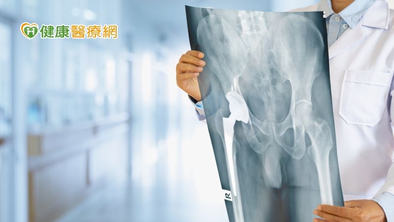 70歲阿嬤輕摔大腿嚴重骨折　醫師鎖鋼釘竟然「鎖不緊」