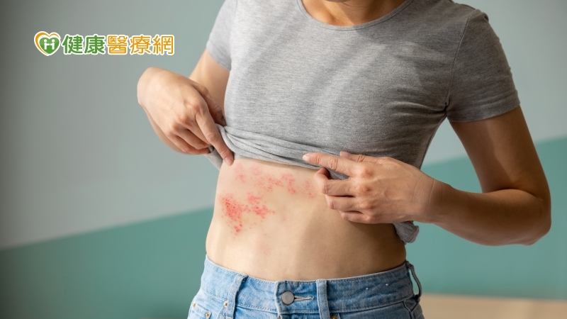 肌膚開始麻癢刺痛　小心可能是帶狀疱疹發病前兆