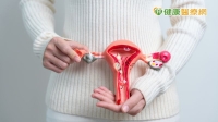 子宮息肉發炎導致不孕　婦科名中醫5招打造好孕體質