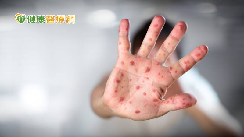 【闢謠】感染麻疹可獲抗體！？　輕忽恐釀重症與嚴重併發症