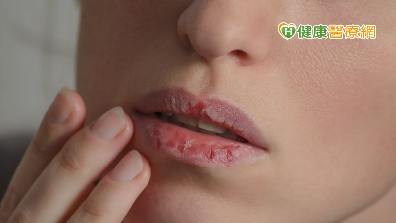 護唇膏越塗越糟糕　可能對成分過敏！