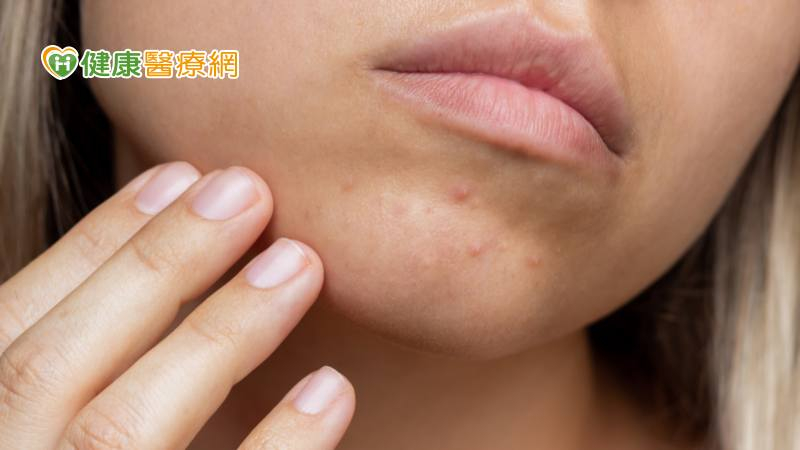 夏天「粉刺、痘痘」大爆發！中西醫合療還你好膚質