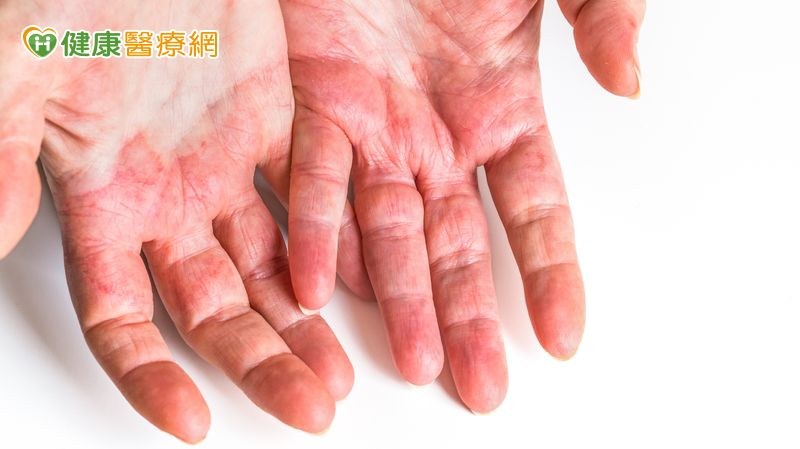 大腸癌患者福音!補充鋅竟能減少標靶藥「手足皮膚反應」 提升治療效果