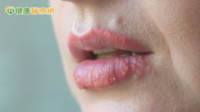 嘴唇乾裂是唇疱疹還是口角炎！  教你一次分清楚及治療