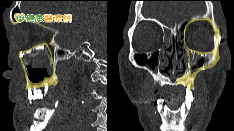 「顏面骨折」未妥善治療恐影響眼睛、咬合！　導航技術助1男精準重建顏面