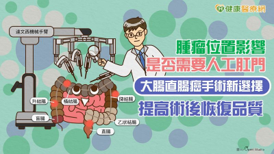 腫瘤位置影響是否需要人工肛門　大腸直腸癌手術新選擇　提高術後恢復品質