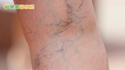 「靜脈曲張」穿彈性襪好惱人！　「特殊組織膠水治療」擺脫束縛