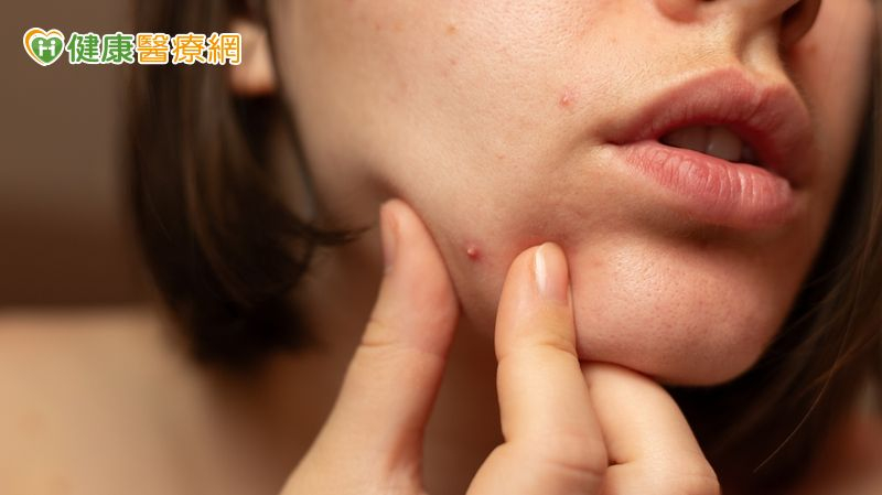 想要有效控痘，應保持良好作息、健康飲食習慣、適度清潔皮膚，且使用任何藥品前務必先諮詢皮膚科醫師或藥師，以確保正確使用，讓您在冬季也能保持清爽健康的皮膚。