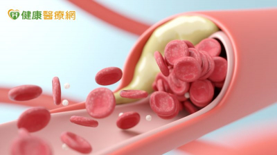 血管嚴重鈣化治療風險高！　「最新治療」用震的疏通血管，減少損傷