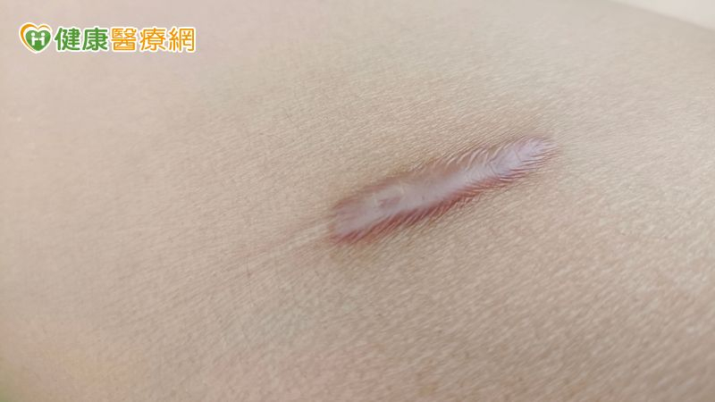 預防蟹足腫的關鍵在於充分認知與即時處理。薛聿涵醫師建議，特別是曾有病史的患者，應謹慎避免任何可能造成皮膚受傷的情況，包括不必要的美容手術、紋身等。