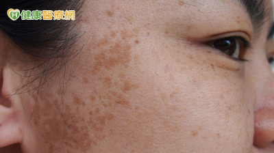 雷射不成反增黑斑！53歲女確診罹患「皮膚癌」
