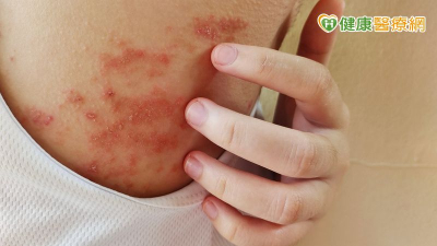 異位性皮膚炎患者有救了！最新治療法曝光　助遠離反覆發作