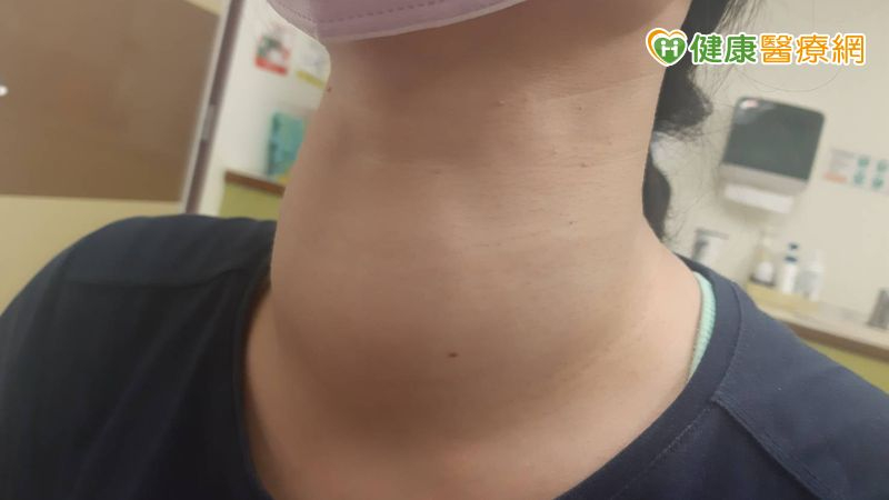 雷夫氏病（Graves’ Disease），是因為自體免疫性抗體刺激甲狀腺，導致分泌過多荷爾蒙的內分泌疾病，與基因遺傳、環境、壓力等因素有關，好發於20至40歲女性。