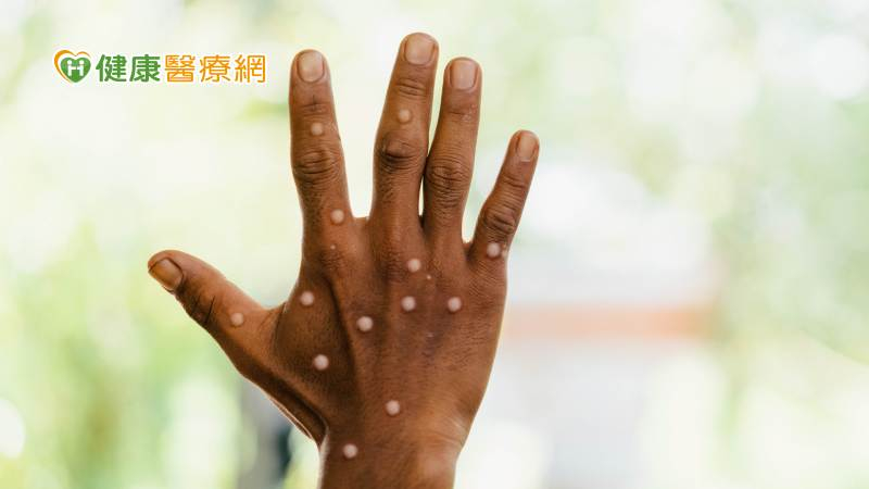 由於M痘疫情仍在全球多個國家持續傳播，世界衛生組織（WHO）召開國際衛生條例第三次緊急委員會後宣布，全球M痘疫情還是繼續維持為「國際關注公共衛生緊急事件（PHEIC）」。