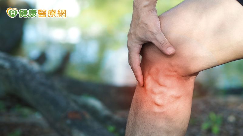 有靜脈曲張或血栓病史、年齡大於40歲、女性（尤其多產婦）、長時間站立或蹲坐者、肥胖者較易發生靜脈曲張。