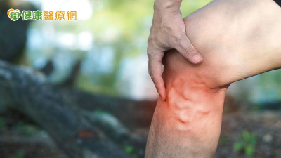 靜脈曲張治療怎麼選？醫解析「最新微創技術」　高齡族群也適合