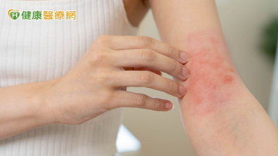 異位性皮膚炎來勢洶洶！　醫授「日常3大保養原則」一定要做到