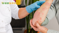 不是一般乾癬！「全身膿疱性乾癬」恐致器官衰竭　勿輕忽皮膚膿疱、脫屑