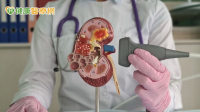 血型不同也能換腎！　「這1醫療突破」成功讓弟弟為姊捐腎延命10年