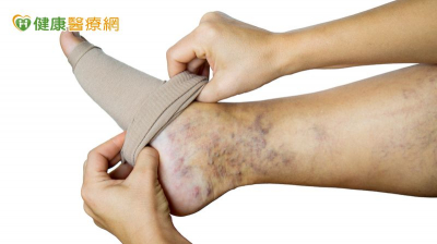 靜脈曲張穿壓力襪過敏沒效？　「這1微創手術」助她找回生活品質