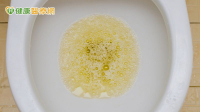 56歲男泡泡尿揭腎病危機！　醫提醒「這些人」務必定期檢查腎功能
