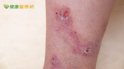 被蚊蟲咬想止癢別用偏方　醫師傳授夏季皮膚保養4原則