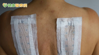 一變天就鼻塞？中醫師：三伏貼改善鼻炎有幫助　但這些人要慎用