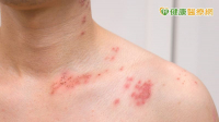 男側腹痛掛泌尿科無異常　三天後出紅疹痛到難眠才知「皮蛇」上身