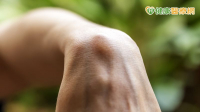 上班族手腕鼓起一顆小山丘？　醫提醒：這些職業族群應多加留意